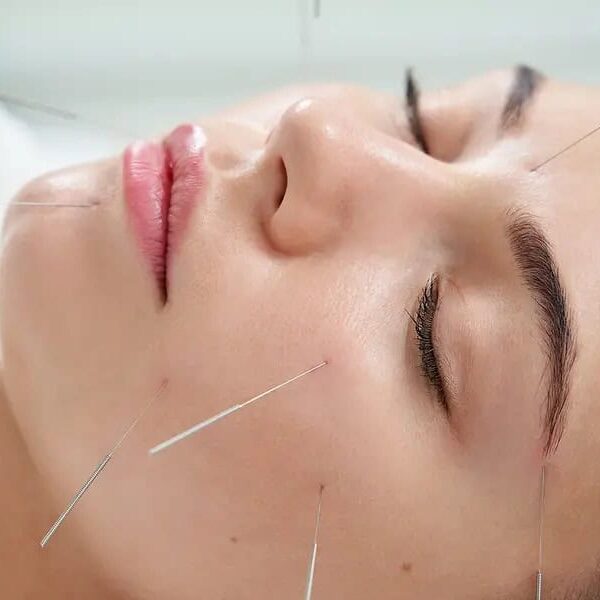 dental-acupuncture-in-beverly-hills-ca